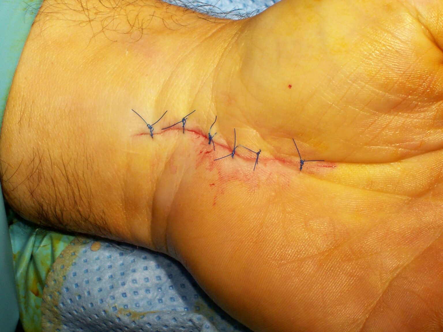 Modern Techniques Used in Carpal Tunnel Surgery NZ for Faster Healing