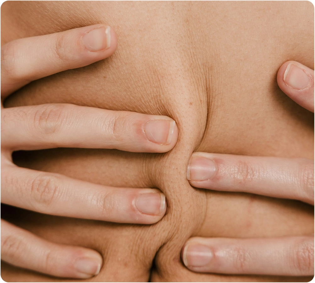 How Lipo Can Target Stubborn Fat After Weight Loss